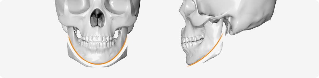 사각턱 성형 시 절개 위치 그림