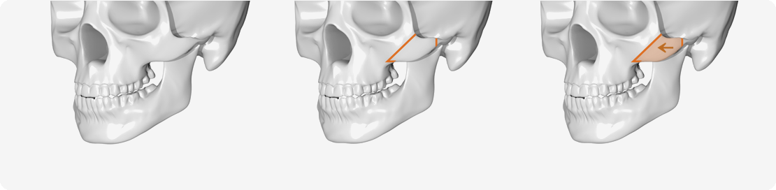 광대뼈 축소 시 절개 위치