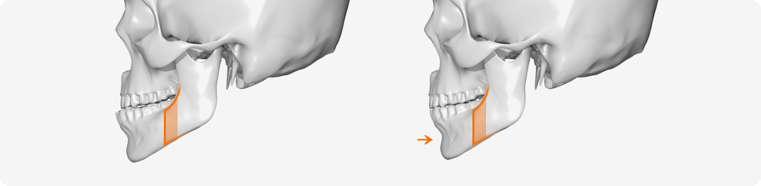 주걱턱 성형 시 절개 위치