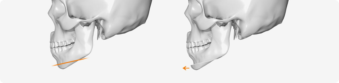 무턱 성형 시 절개 위치